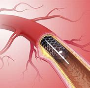 Image result for Vascular Stent Surgery