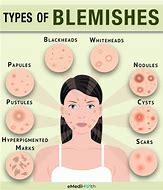 Image result for Pimple Blemish