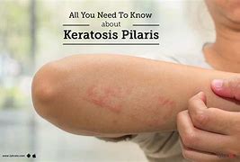 Image result for Keratosis Pilaris Causes