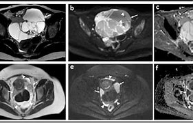 Image result for Thecoma Ovary MRI