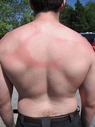 Image result for Irish SunBurn