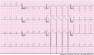 Image result for ECG