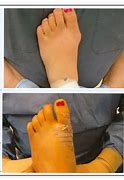 Image result for Bunions in Kids