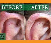 Image result for Basal Cell Skin Cancer Ear