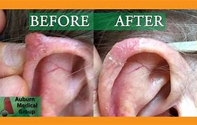 Image result for Basal Cell Carcinoma On-Ear