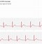 Image result for ECG Apple Watch Inconclusive