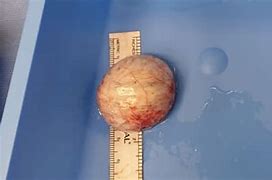 Image result for Teratoma Tumor with Teeth and Hair