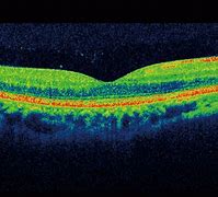 Image result for Macular OCT Images