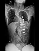Image result for Scoliosis of Lumbar Spine
