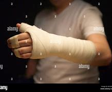 Image result for Broken Arm Plaster Cast