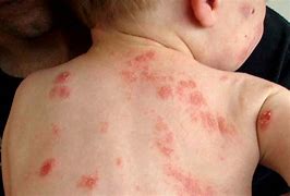 Image result for Eczema 2 Year Old
