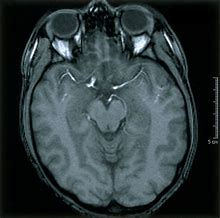 Image result for Normal MRI Scan of Brain