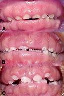 Image result for Hereditary Gingival Fibromatosis