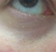 Image result for White Bumps around Eyes