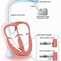 Image result for Artificial Heart Pacemaker
