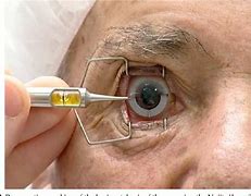 Image result for Intraocular Lens Replacement