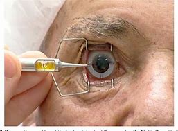 Image result for Cataract Surgery Intraocular Lens