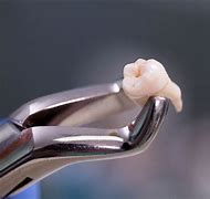 Image result for Incisor Tooth Extraction