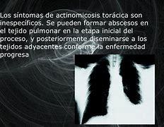 Image result for actimomicosis