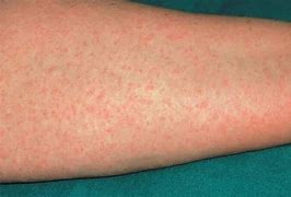 Image result for Food Allergy Rashes
