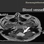 Image result for Papilloma Brain Tumor