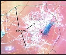 Image result for Morgellons