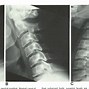 Image result for Anterior Subluxation Cervical Spine