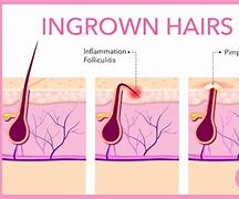 Image result for Boil vs Ingrown Hair