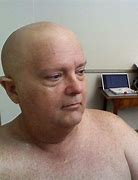 Image result for Burnt Bald Headed