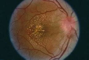 Image result for Syphilis Oct Retina