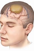 Image result for Meningioma Brain Tumors 1 Cm
