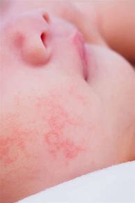 Image result for Food Allergy Rash Baby Face