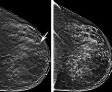 Image result for Cáncer Tumor Pictures