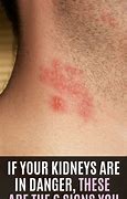 Image result for Kidney Failure Skin Rash