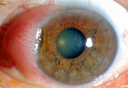 Image result for Conjunctival Papilloma Pterygium