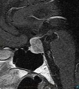 Image result for Tumor On Pituitary Gland