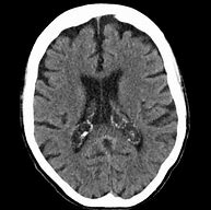 Image result for Choroid Plexus CT Scan
