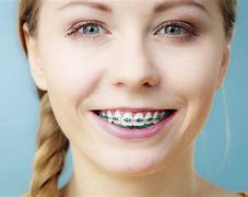 Image result for Wearing Braces