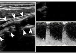 Image result for Carotid Stenosis Ultrasound