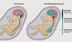 Image result for Anencephaly vs Rachischisis