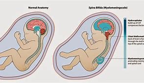 Image result for Anencephaly Folate