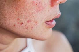 Image result for Polycystic Ovary Syndrome Acne
