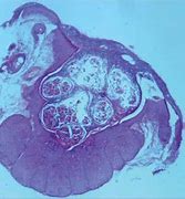 Image result for Molluscum Papules