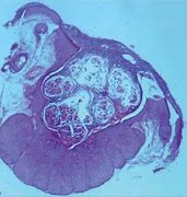Image result for Severe Molluscum Contagiosum