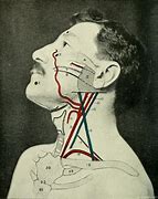 Image result for Carotid Control Hold