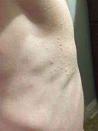 Image result for Molluscum Bumps On Skin