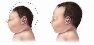 Image result for Microcephaly and Macrocephaly