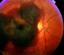 Image result for De Generacion Macular Seca