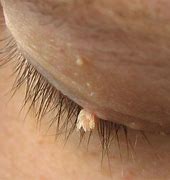 Image result for Wart On Eyelid