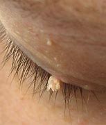 Image result for Filiform Wart or Skin Tag